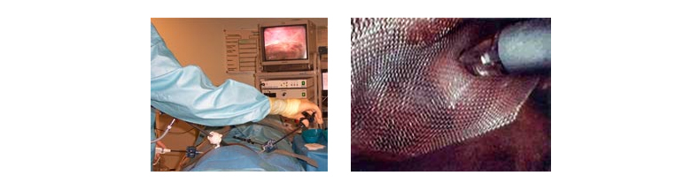 hernia surgery