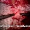 Лапароскопска трансабдоминална преперитонеална херниопластика при левостранна индиректна слабинна херния