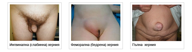 hernia