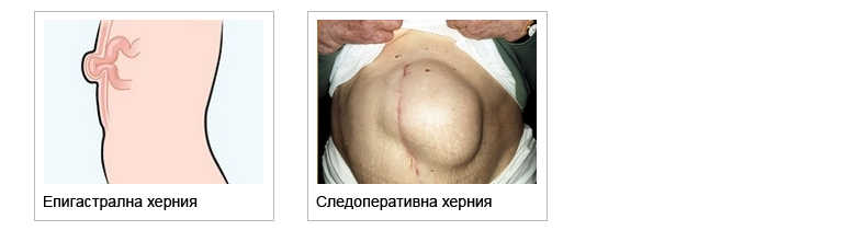 hernia 2