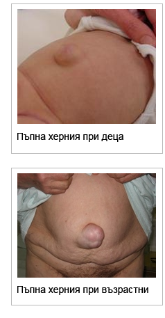 hernia 3