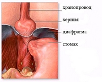 Хиатална херния